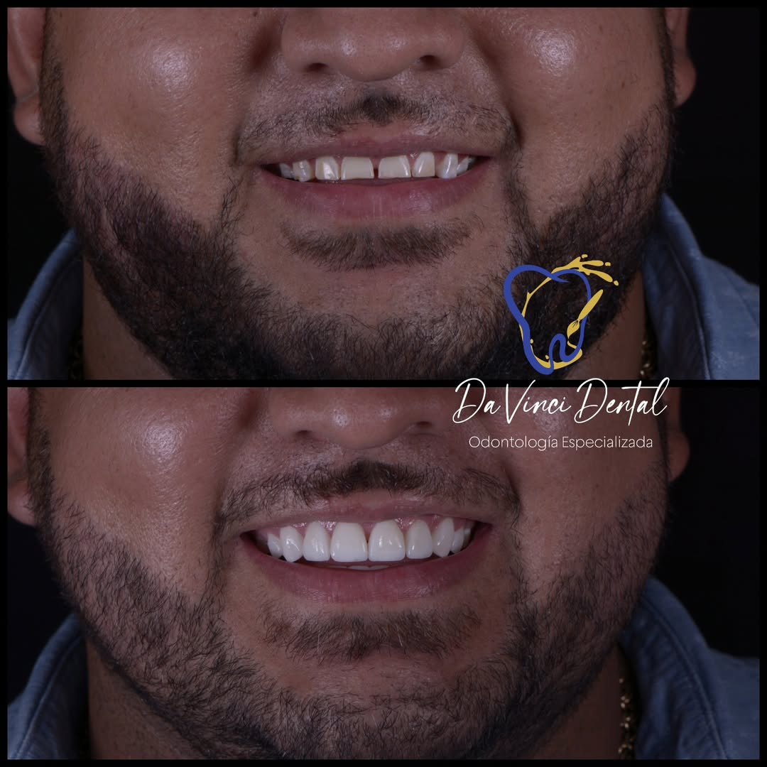 Caso 1 antes y después